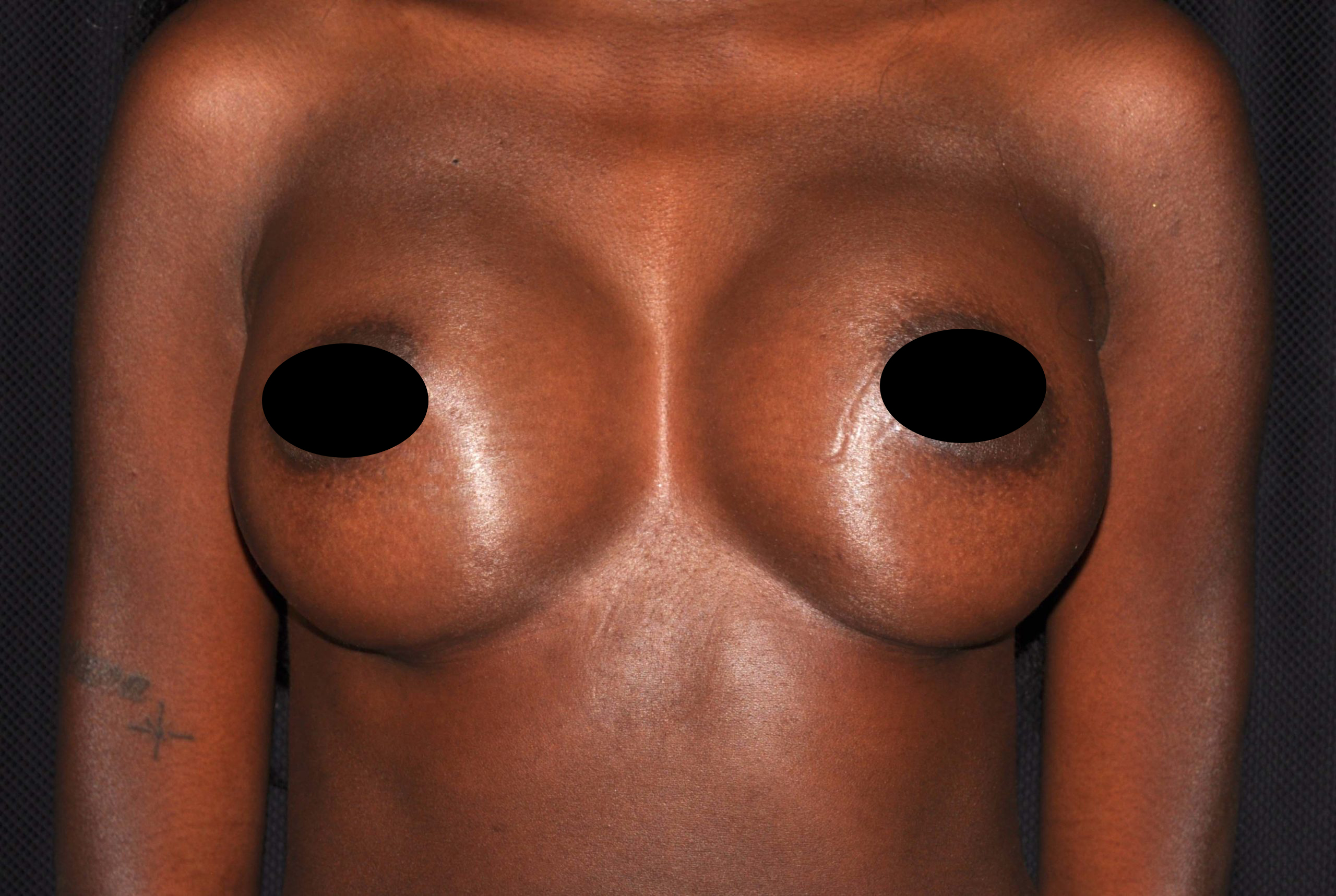 Breast Augmentation Before and After