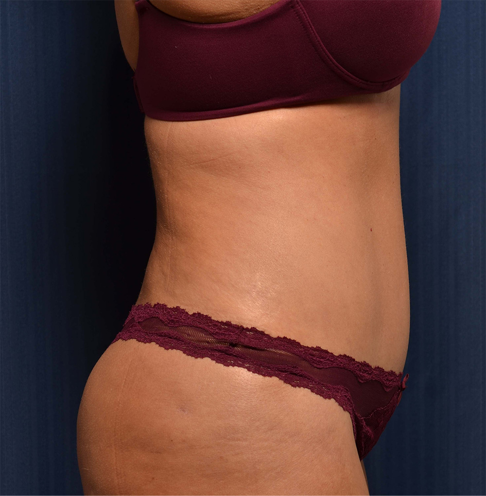 Tummy Tuck