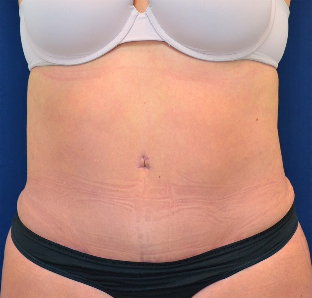 Tummy Tuck