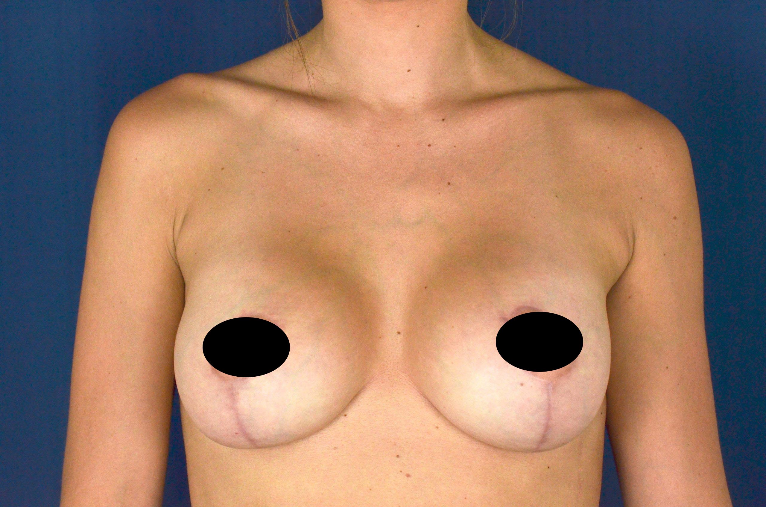 Breast Augmentation with Lift