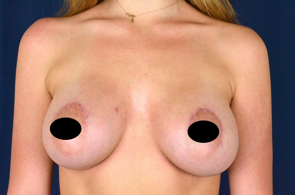 Breast Augmentation with Lift