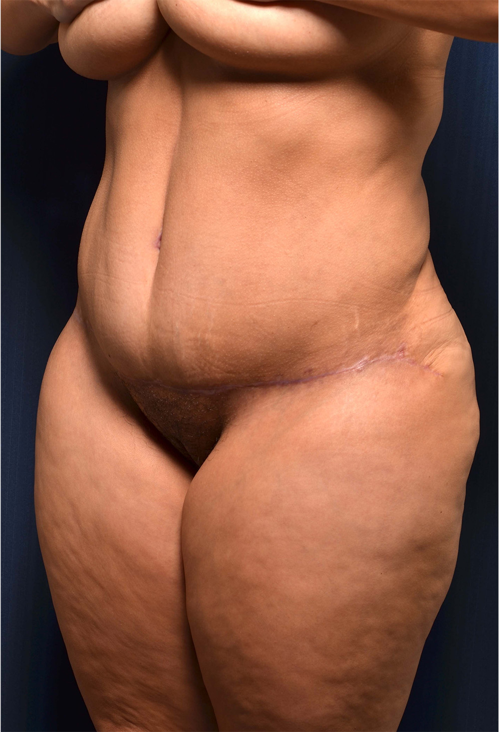 Tummy Tuck