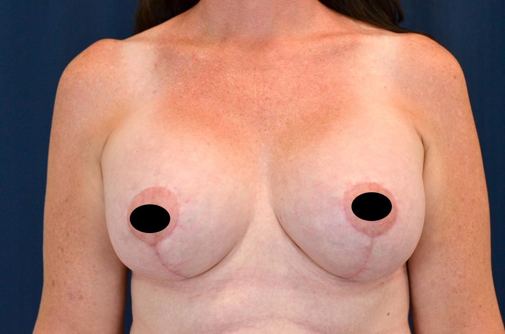 Breast Augmentation with Lift