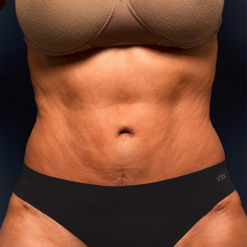 Tummy Tuck