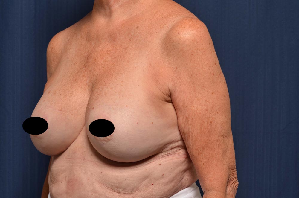 Breast Augmentation with Lift