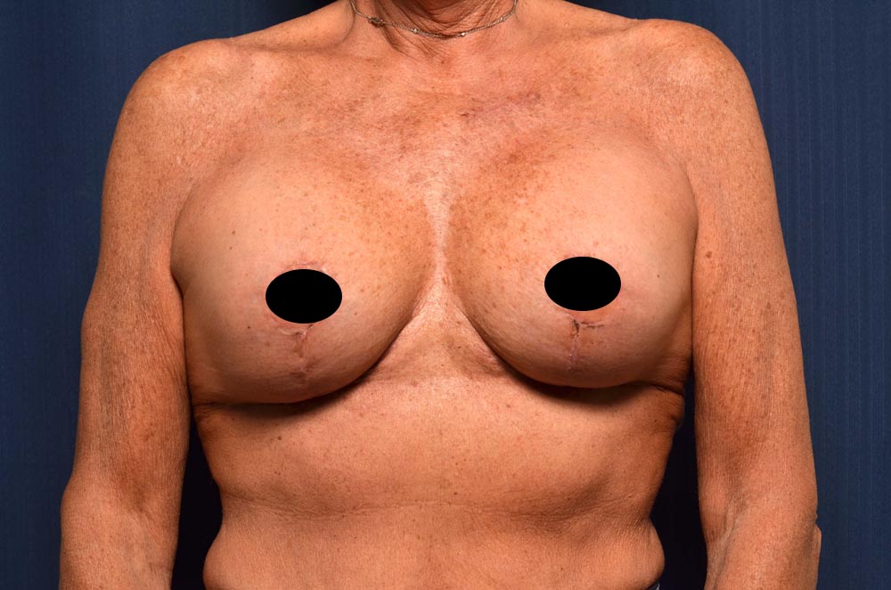 Breast Augmentation with Lift