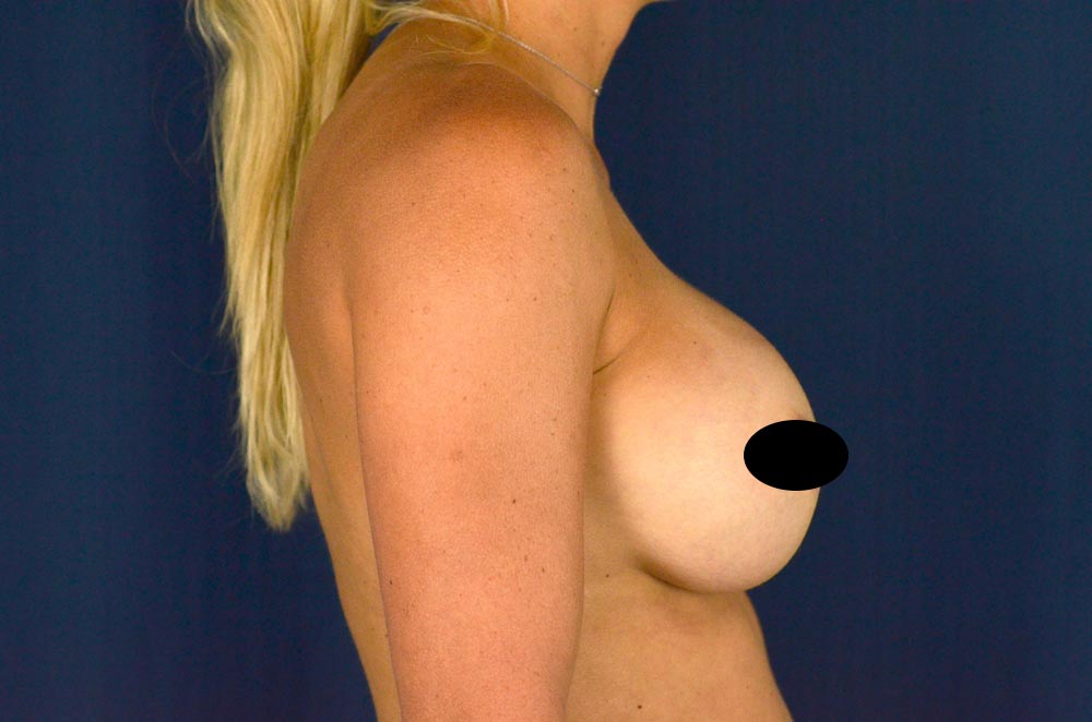 Breast Implant Revision