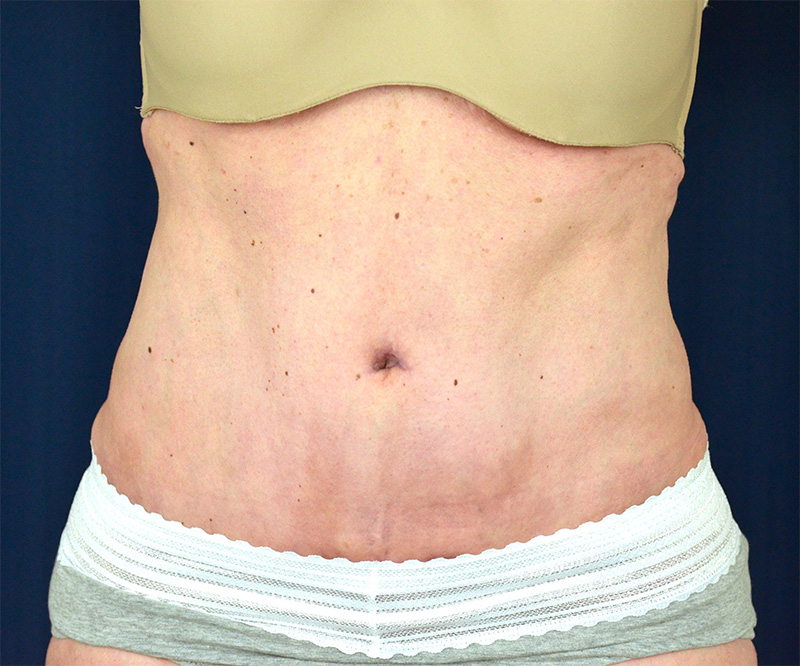 Tummy Tuck