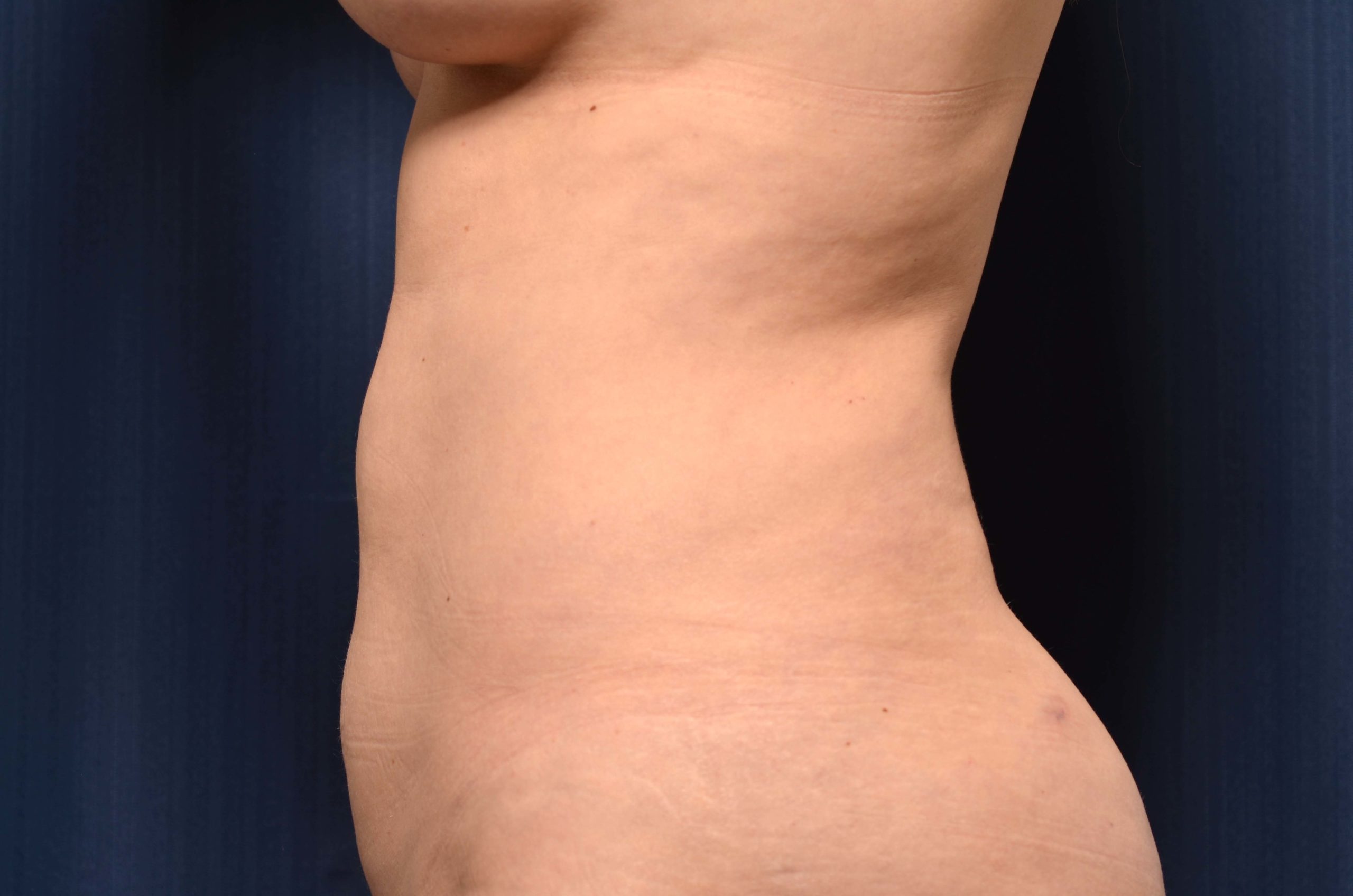 Liposuction