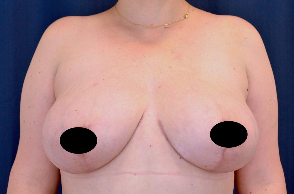 Breast Lift Reduction