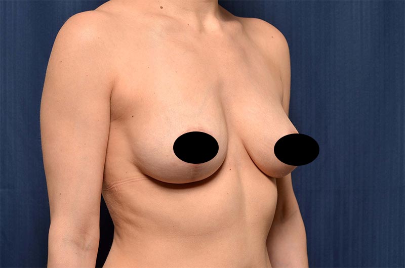 Breast Lift Reduction