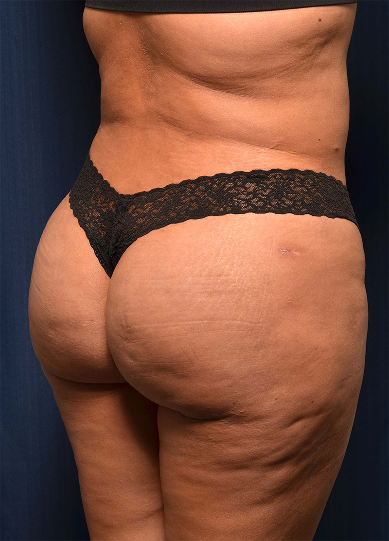 Brazilian Butt Lift Before & After