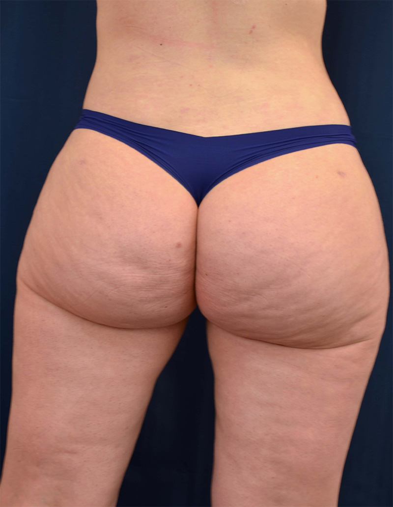 Brazilian Butt Lift Before & After