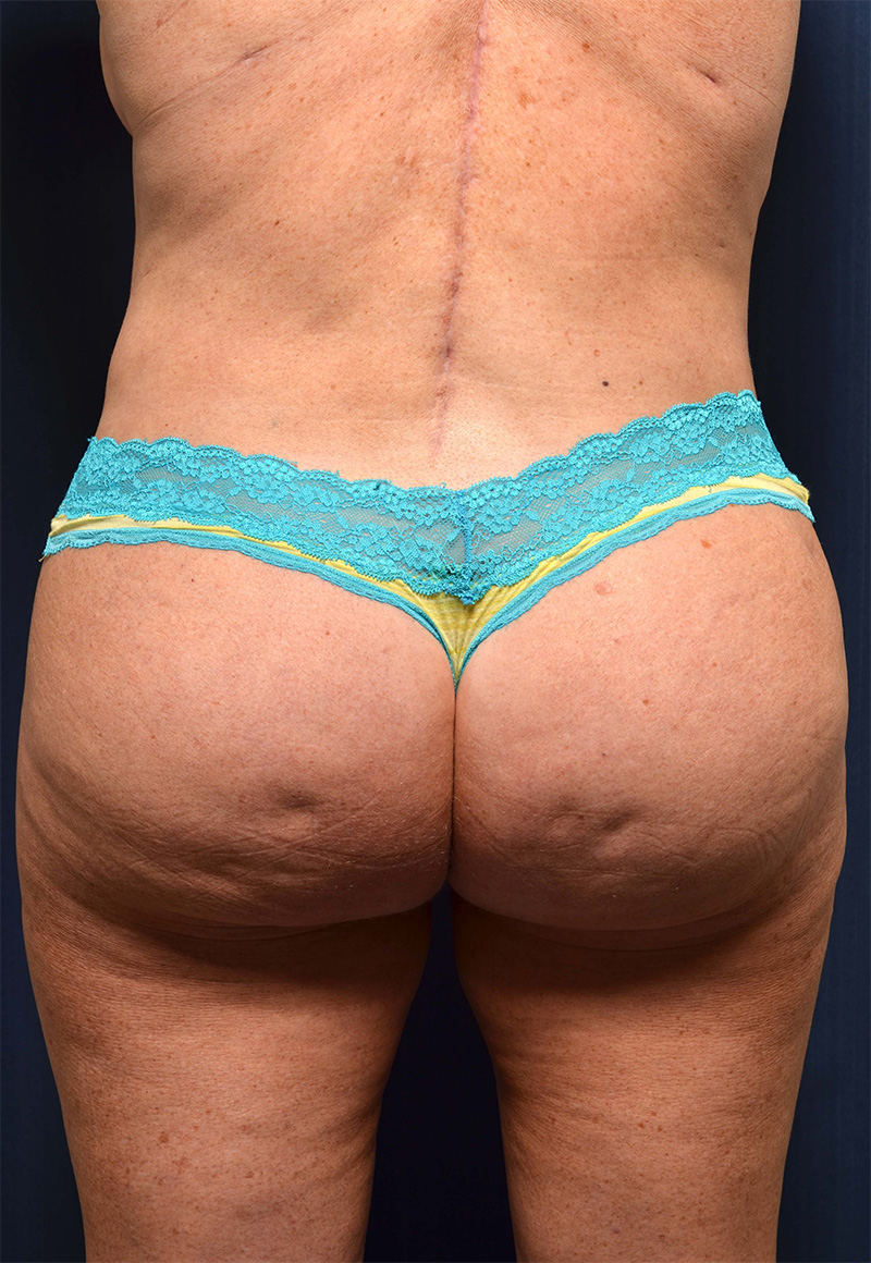 Brazilian Butt Lift Before & After