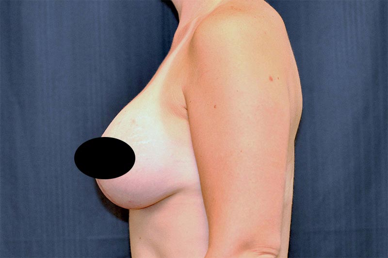 Breast Augmentation with Lift