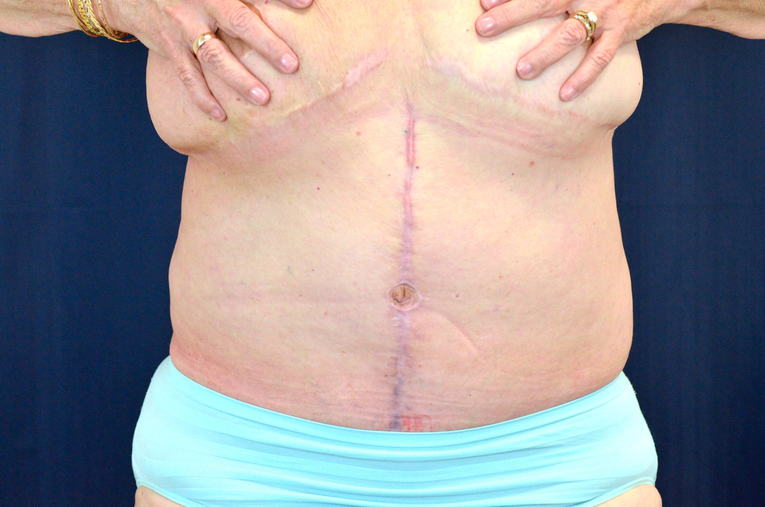 Tummy Tuck