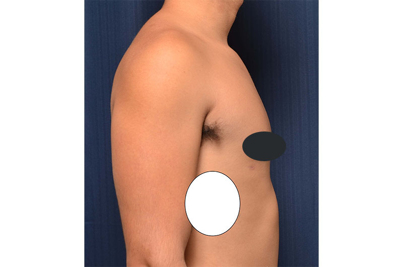 Gynecomastia