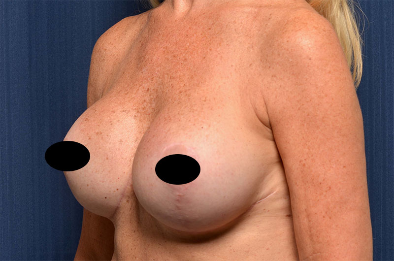 Breast Implant Revision