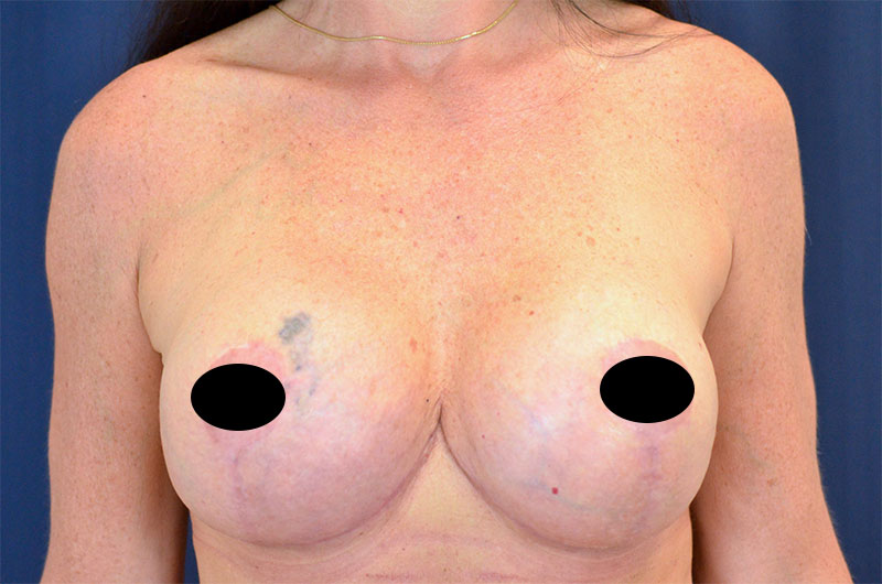 Breast Implant Revision