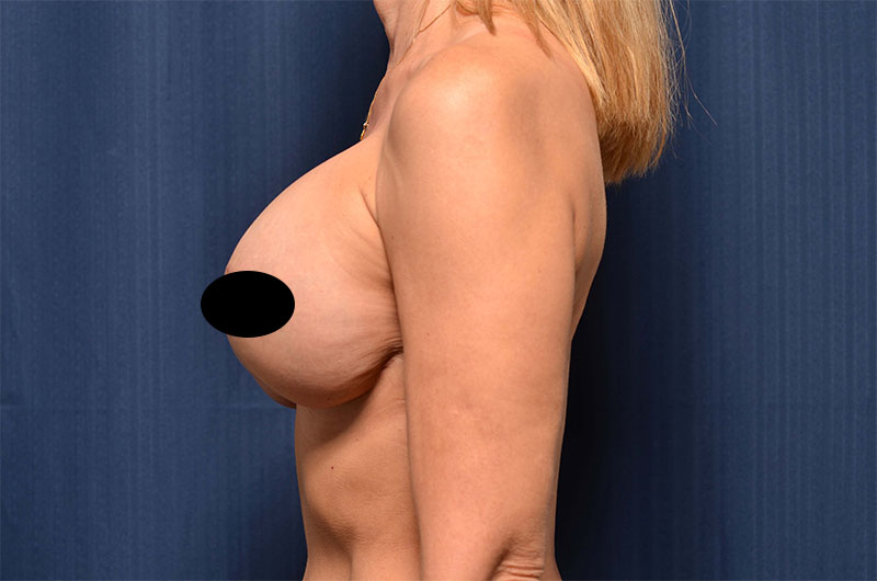 Breast Implant Revision