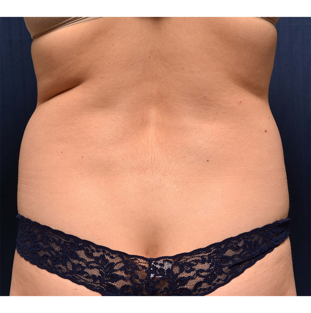 Liposuction