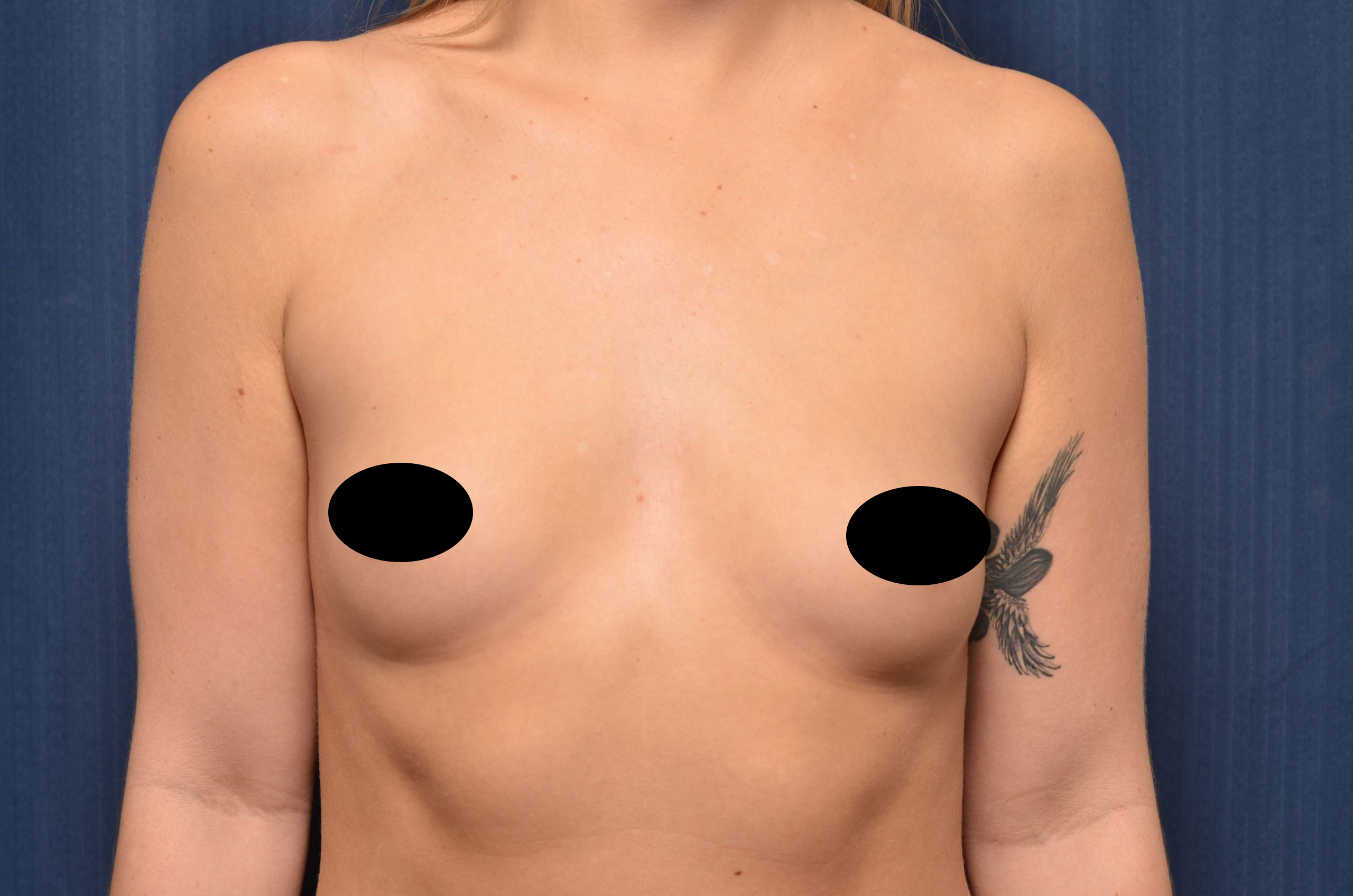 Breast Augmentation Before and After