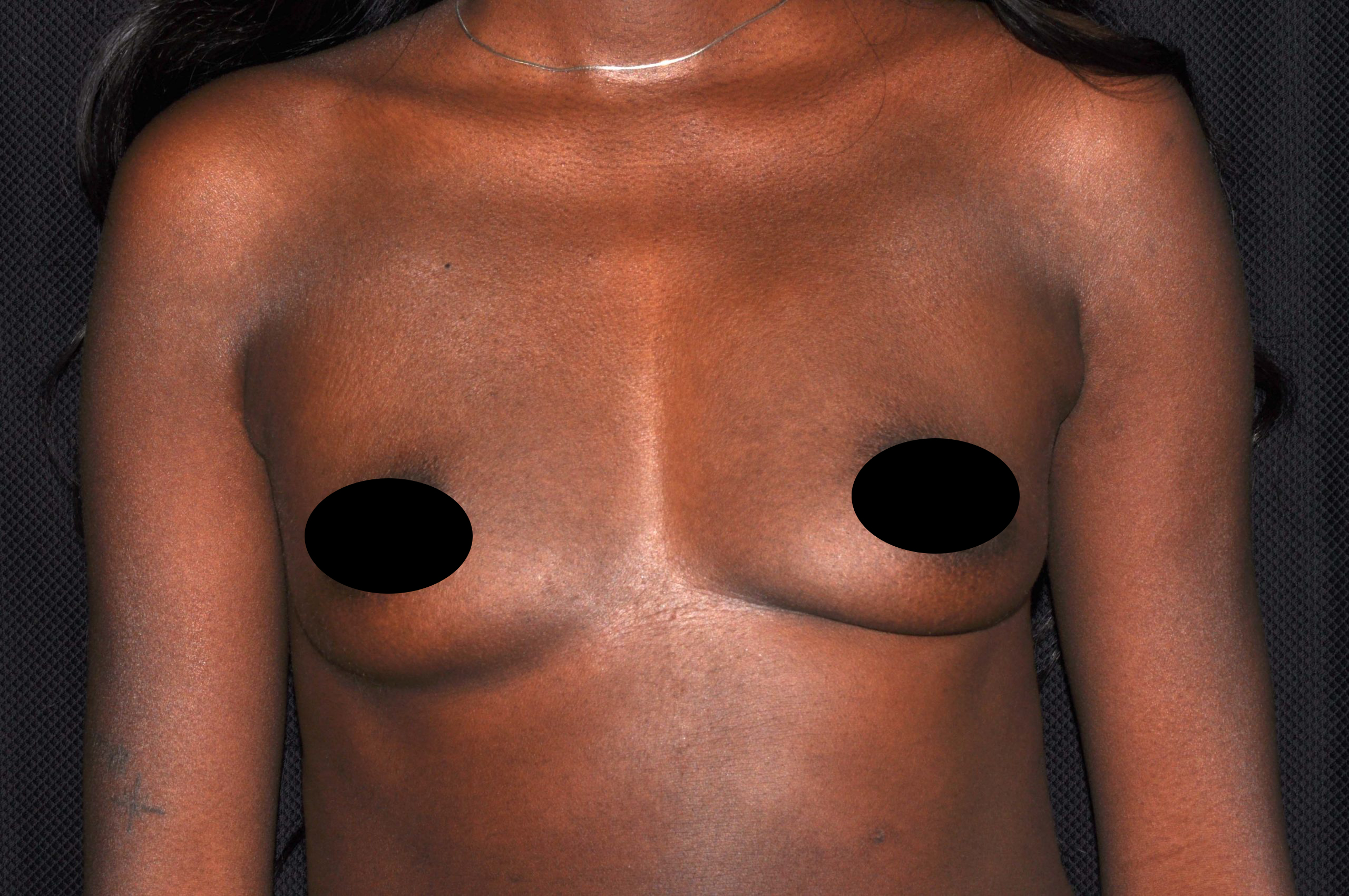 Breast Augmentation Before and After