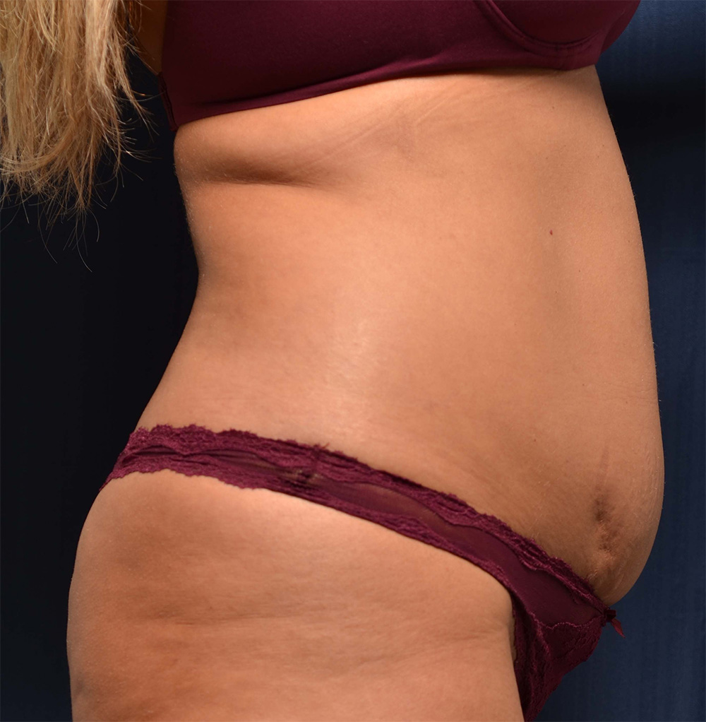 Tummy Tuck