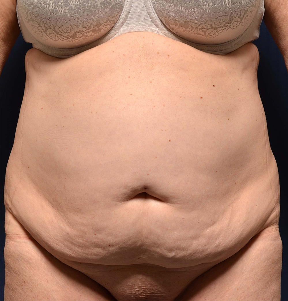 Tummy Tuck