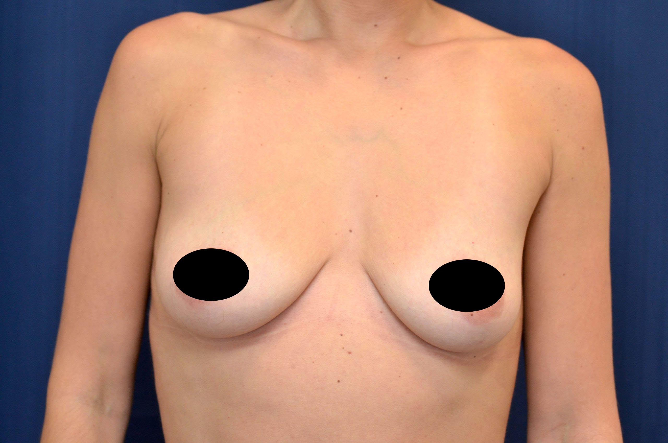 Breast Augmentation with Lift