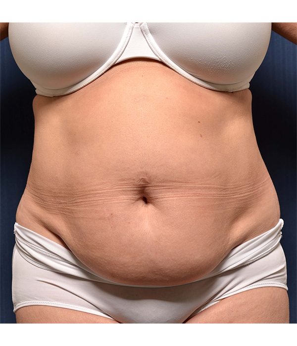 Tummy Tuck