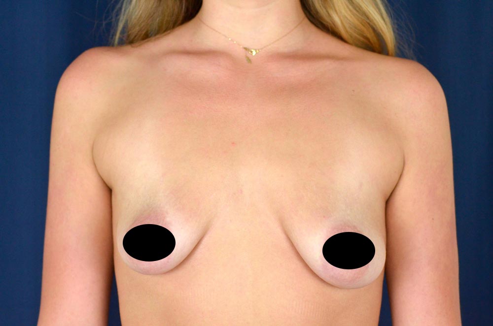 Breast Augmentation with Lift