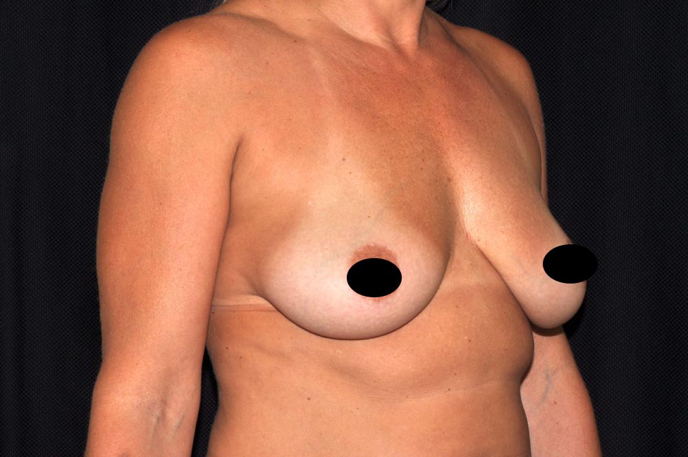 Breast Augmentation with Lift