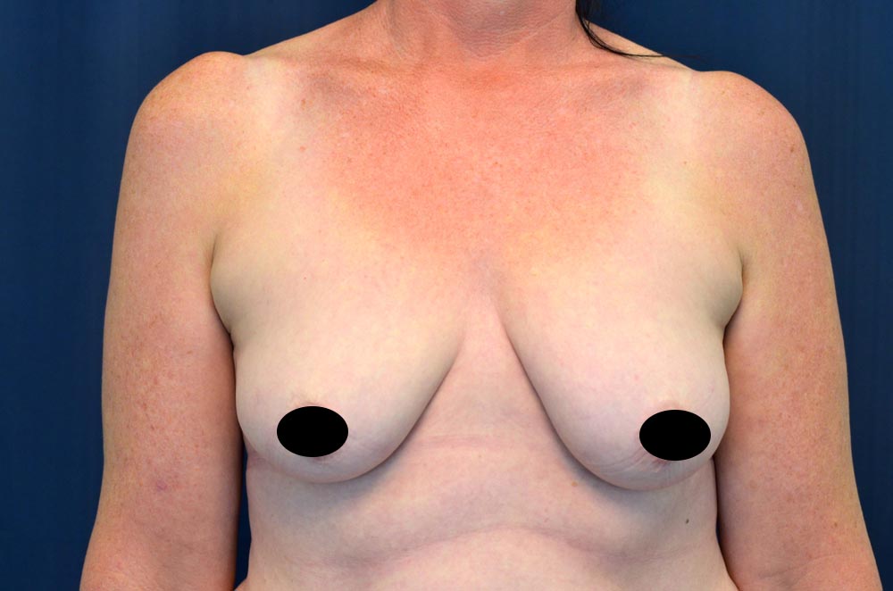 Breast Augmentation with Lift