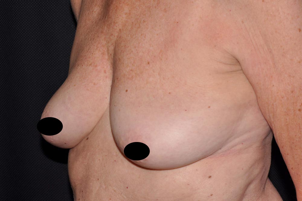 Breast Augmentation with Lift