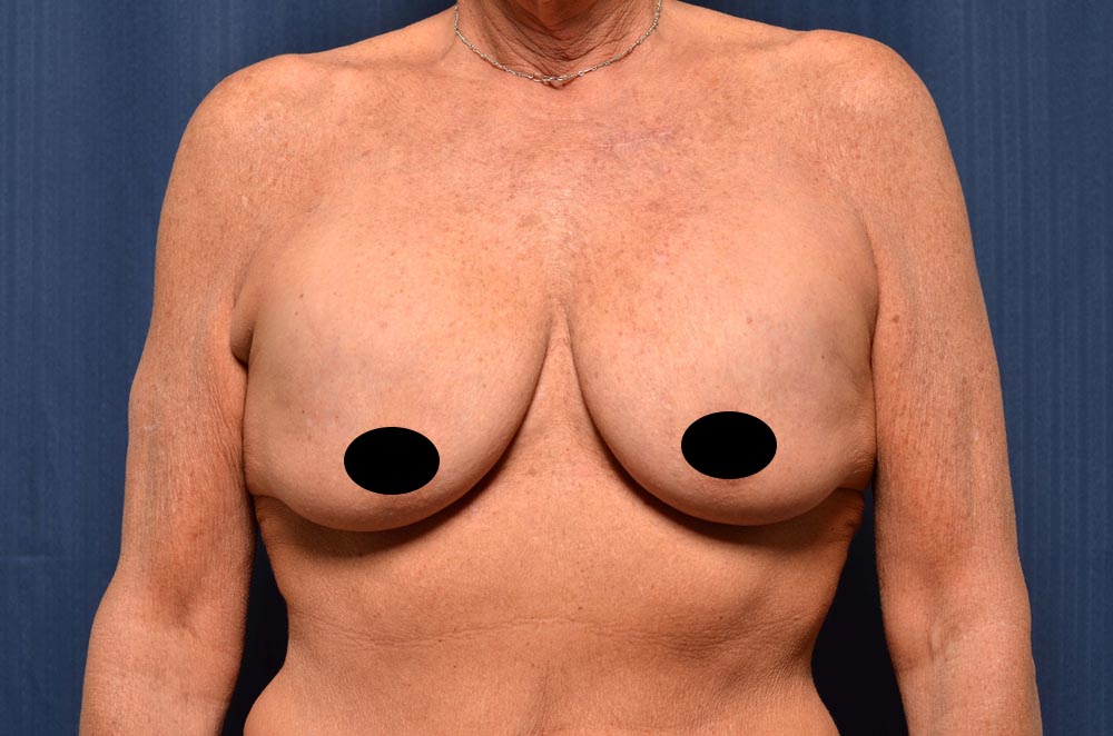 Breast Augmentation with Lift