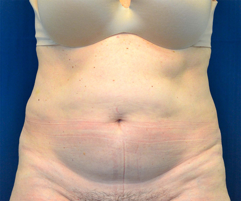 Tummy Tuck