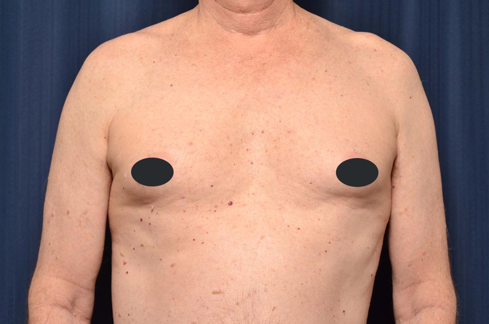 Gynecomastia