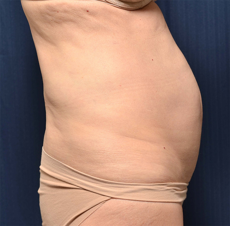 Tummy Tuck