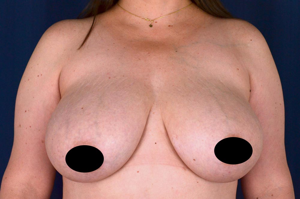 Breast Lift Reduction