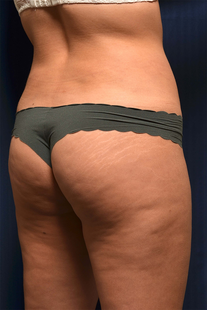 Brazilian Butt Lift Before & After