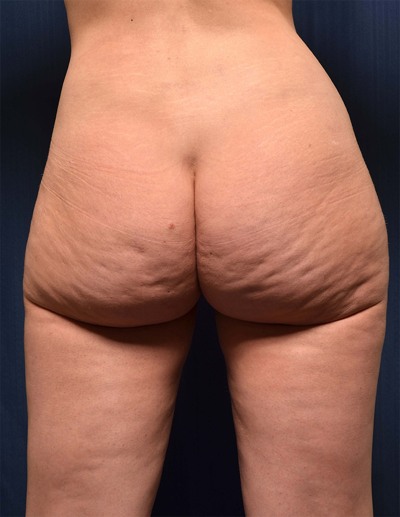 Brazilian Butt Lift Before & After