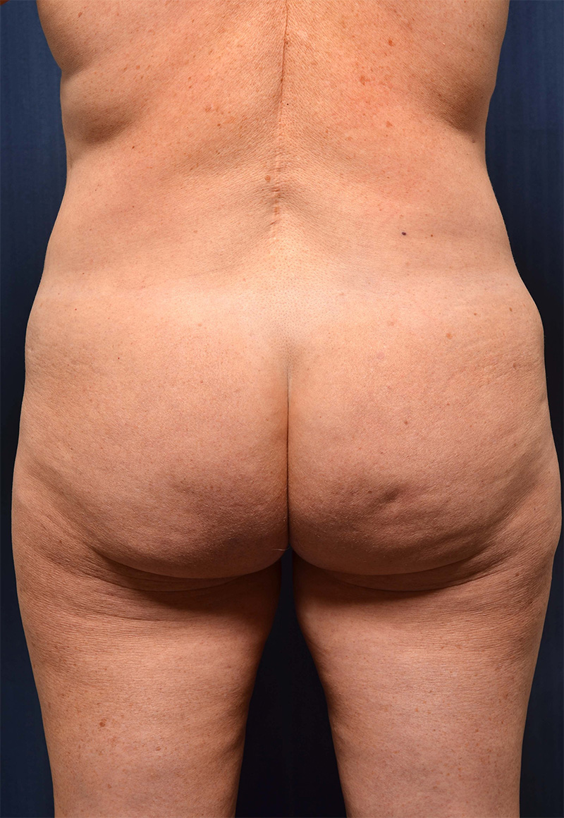 Brazilian Butt Lift Before & After