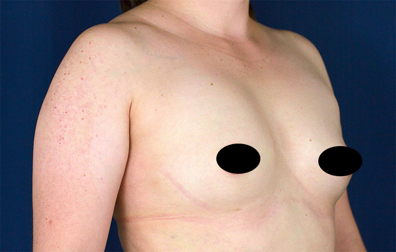 Breast Augmentation Before and After