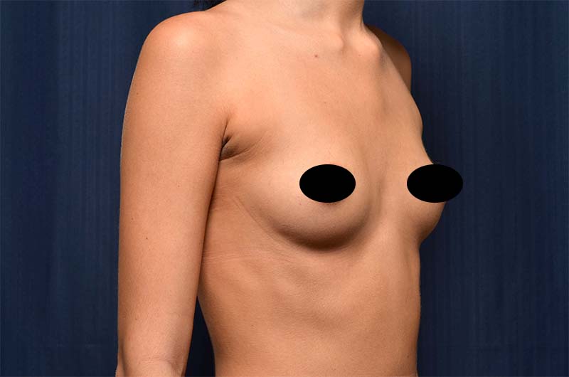 Breast Augmentation Before and After