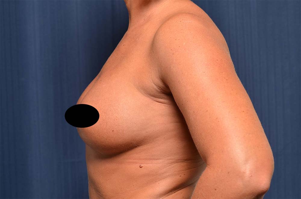 Breast Augmentation Before and After