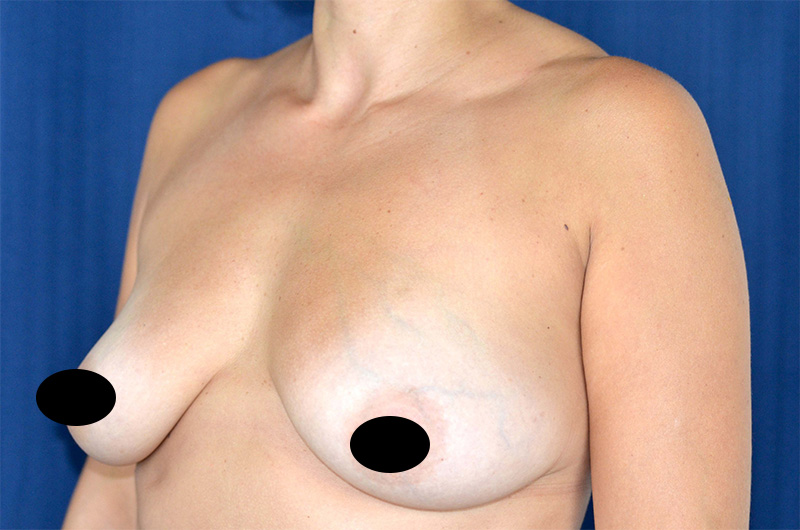 Breast Augmentation with Lift