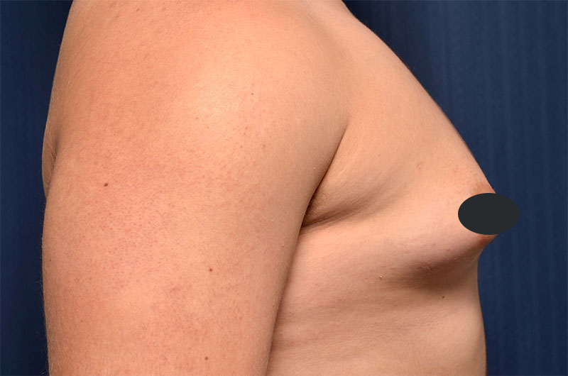 Gynecomastia