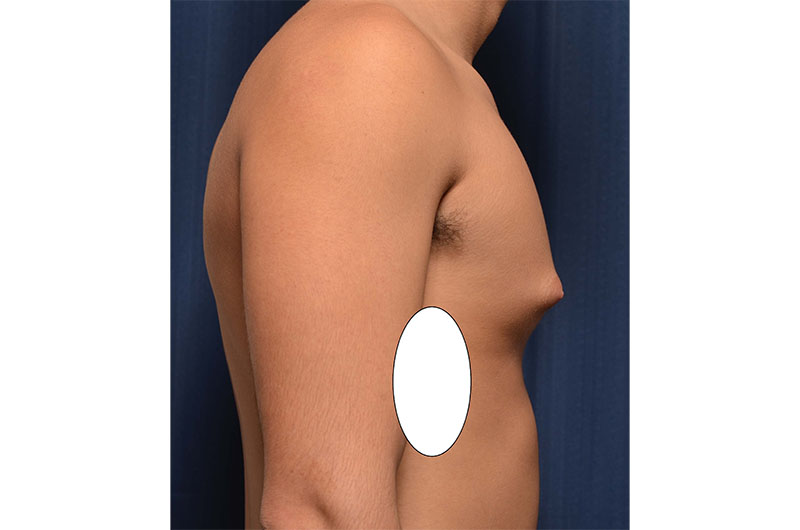 Gynecomastia