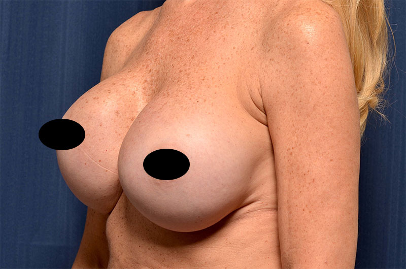 Breast Implant Revision